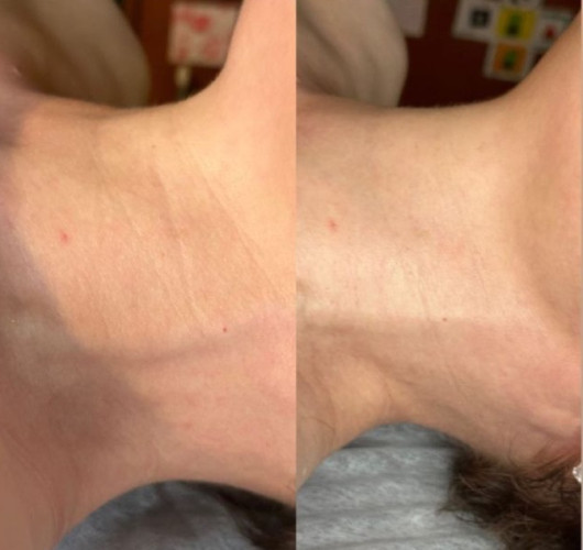 Міоліфтинговий масаж ообличчя фото 3