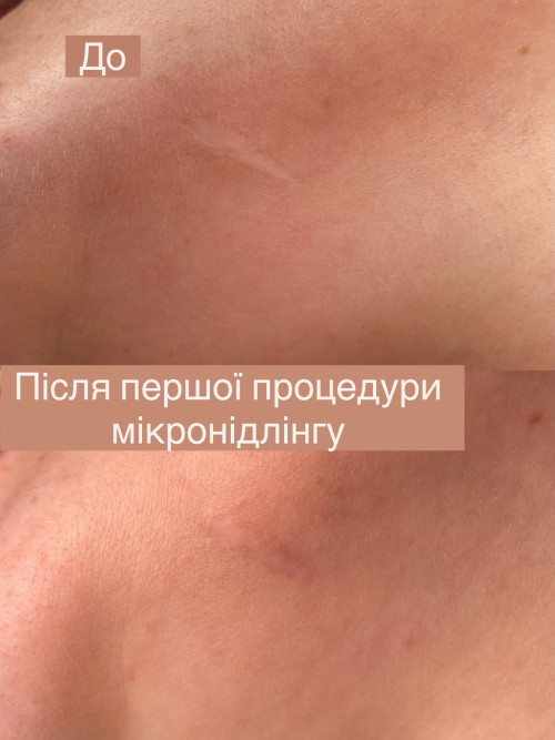 Видалення рубців , розтяжок. Лікування випадіння волосся , мезотерапія фото 3