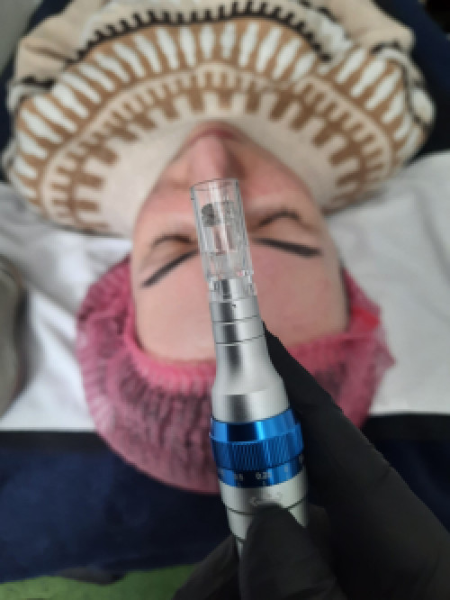 Косметолог метро Лівобережна (чистки,пілінг,мікронідлінг,карбоксі) фото 3