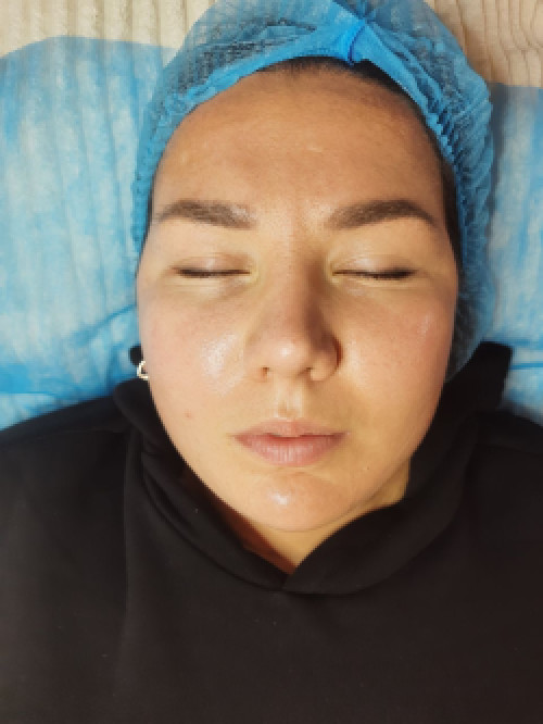 Косметолог метро Лівобережна (чистки,пілінг,мікронідлінг,карбоксі) фото 5