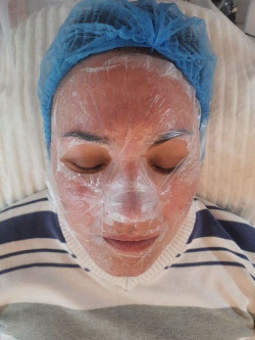 Косметолог метро Лівобережна (чистки,пілінг,мікронідлінг,карбоксі) фото 6